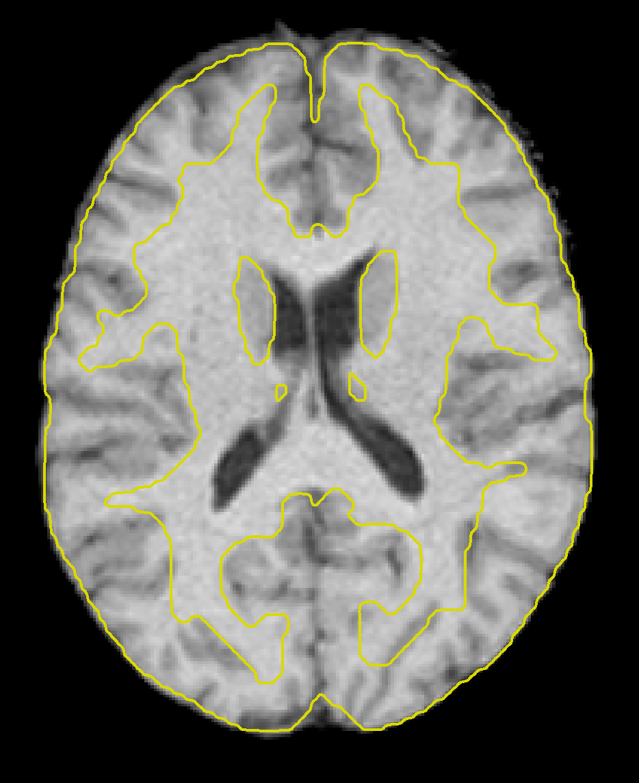 ../../_images/06_Anatomical_MNI.png