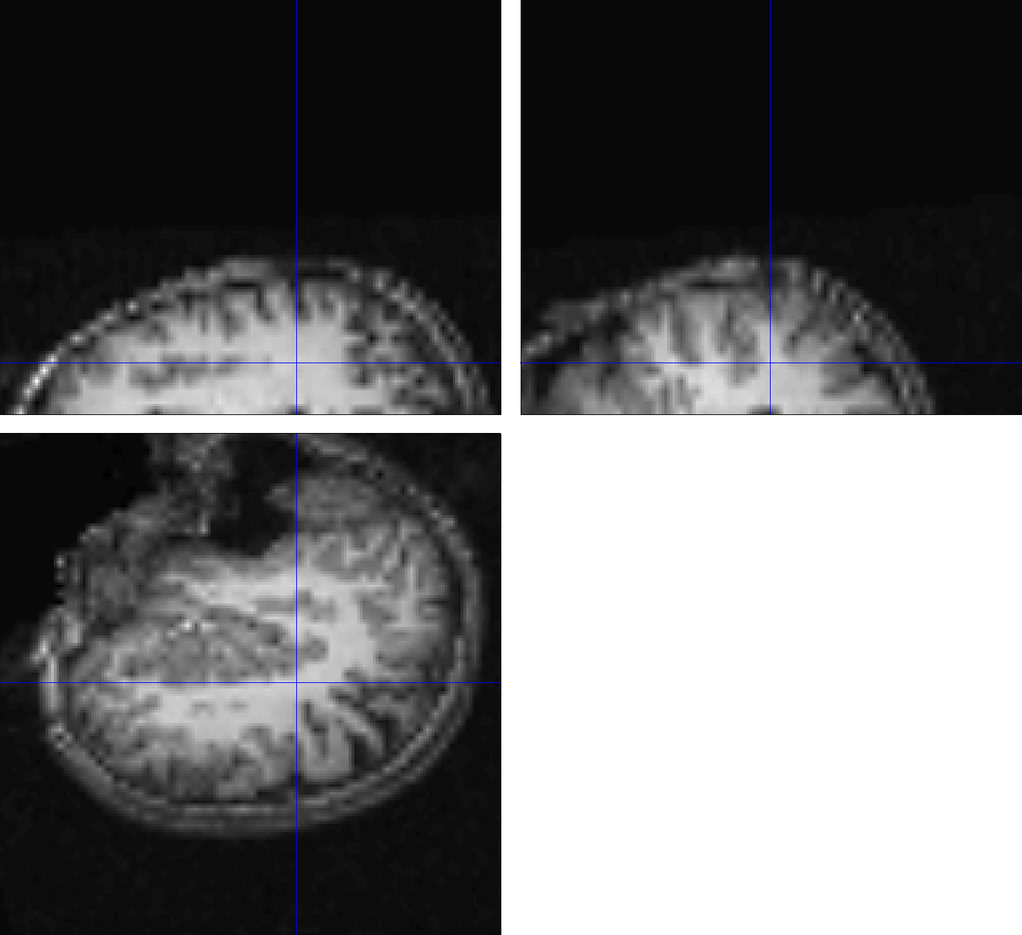 ../../_images/07_CoregistrationError_Anatomical.png