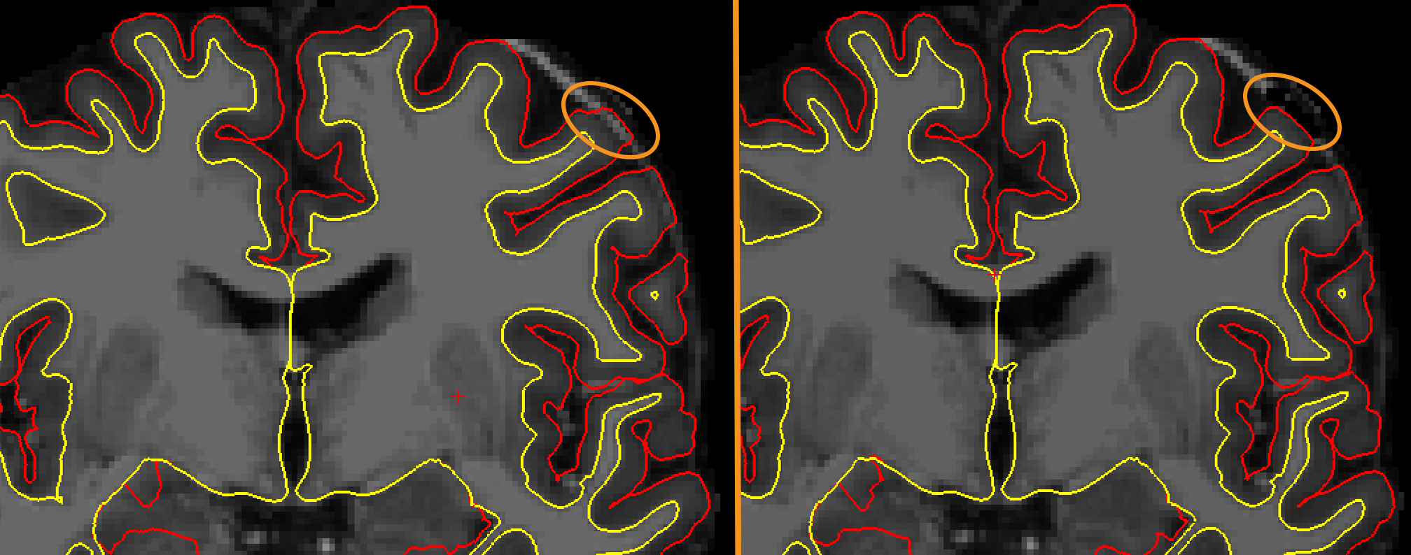 ../../_images/13_PialSurface_Edit_Before_After.png